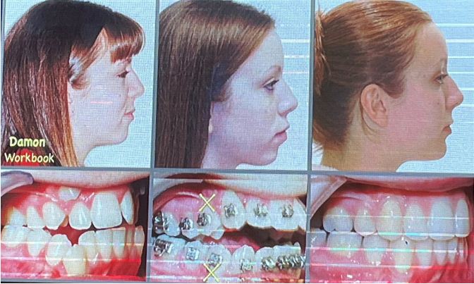Hình ảnh bệnh nhân điều trị có nhổ răng hàm nhỏ